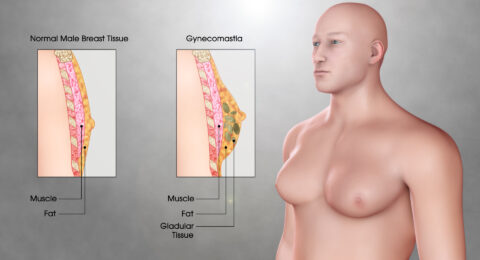 Gynecomastia