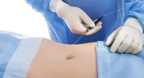 Laser-Assisted-Liposuction-4